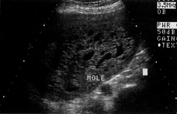 dating pregnancy with early ultrasound